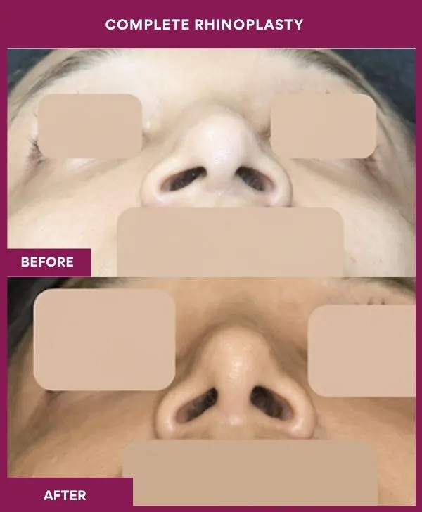 complete-rhinoplasty-surgery-before-after-results-mumbai-india-patient05-front-up