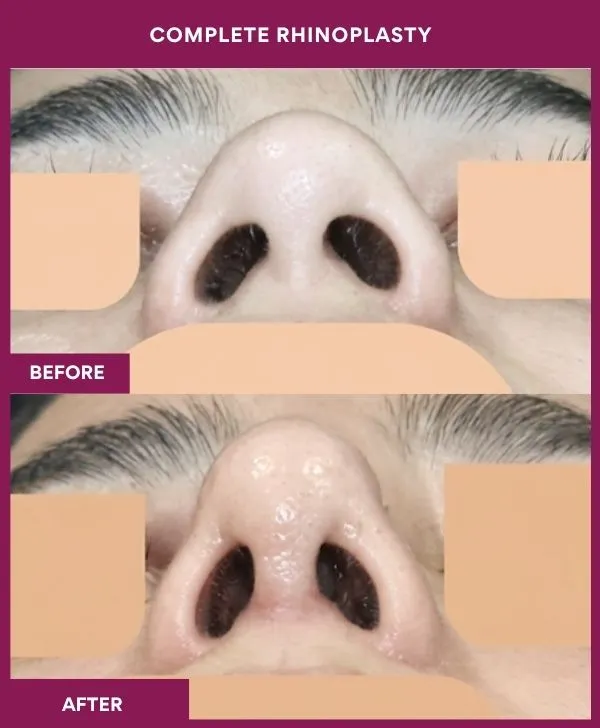 complete-rhinoplasty-surgery-before-after-results-mumbai-india-patient06-front-up