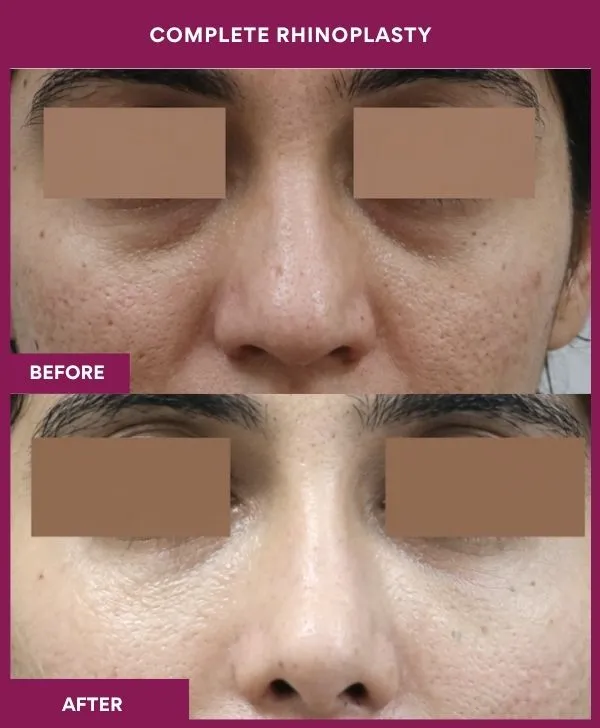 complete-rhinoplasty-surgery-before-after-results-mumbai-india-patient07-front