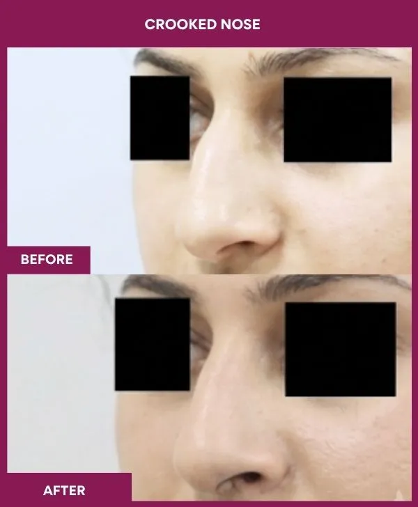 crooked-nose-rhinoplasty-before-after-results-mumbai-india-patient01-front-left