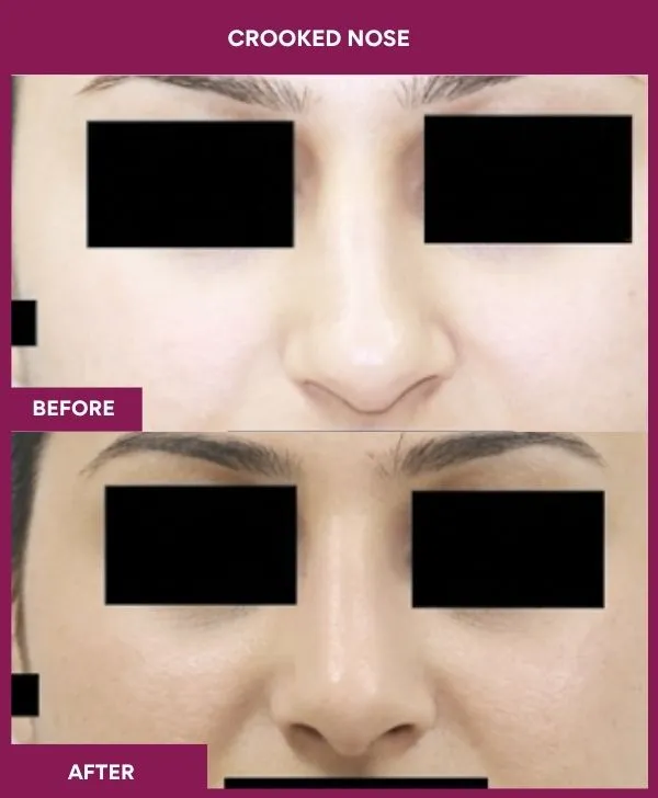 crooked-nose-rhinoplasty-before-after-results-mumbai-india-patient01-front