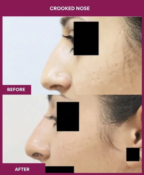 crooked-nose-rhinoplasty-before-after-results-mumbai-india-patient01-side-left