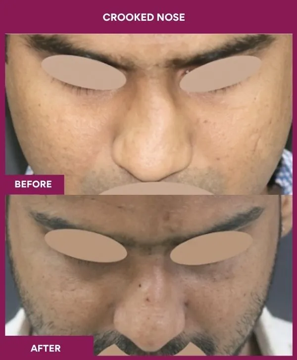 crooked-nose-rhinoplasty-before-after-results-mumbai-india-patient02-front-down