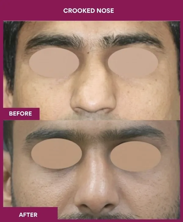 crooked-nose-rhinoplasty-before-after-results-mumbai-india-patient02-front