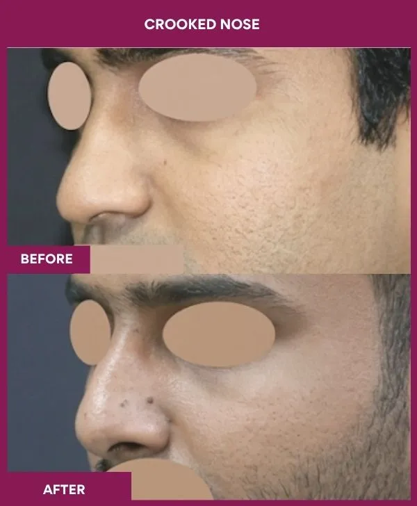 crooked-nose-rhinoplasty-before-after-results-mumbai-india-patient02-side-left
