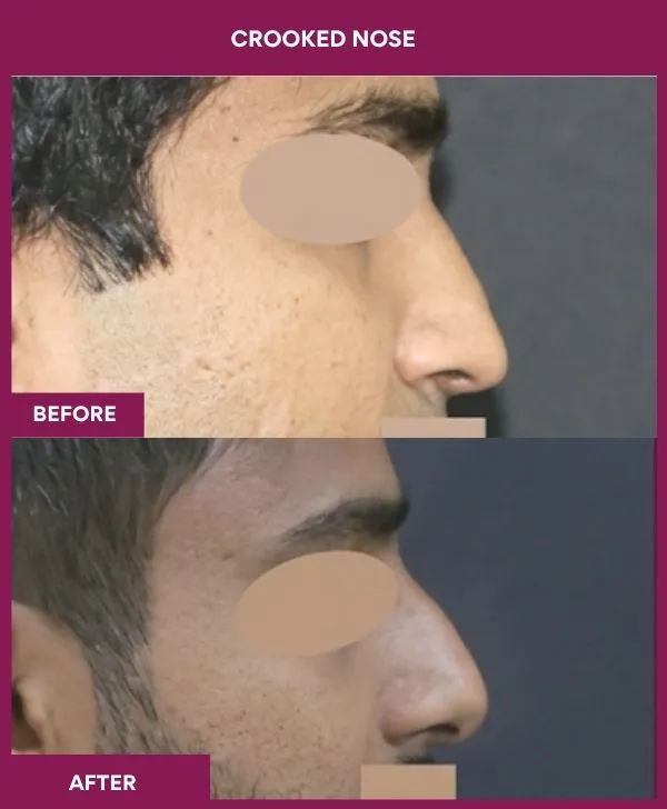 crooked-nose-rhinoplasty-before-after-results-mumbai-patient02-side-right