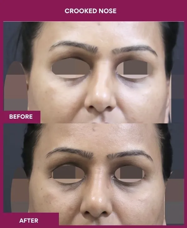 crooked-nose-rhinoplasty-before-after-results-mumbai-india-patient03-front