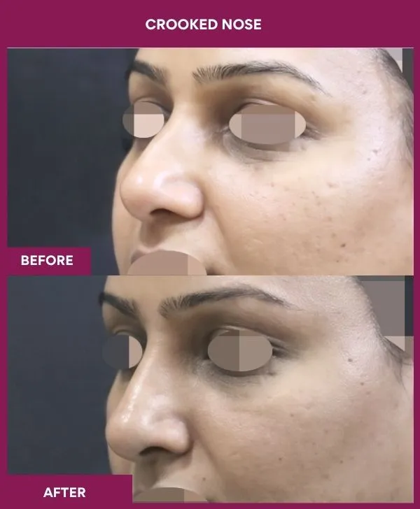 crooked-nose-rhinoplasty-before-after-results-mumbai-india-patient03-side-left