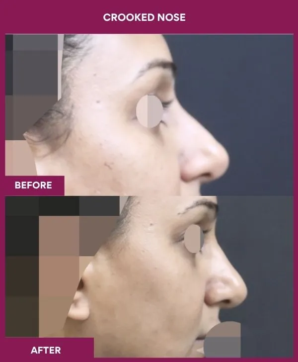 crooked-nose-rhinoplasty-before-after-results-mumbai-india-patient03-side-right