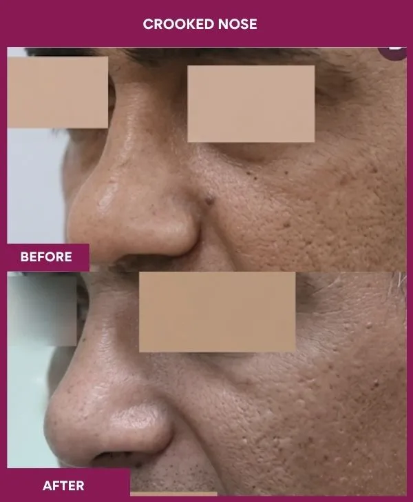 crooked-nose-rhinoplasty-before-after-results-mumbai-india-patient04-front