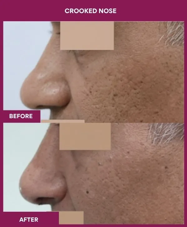 crooked-nose-rhinoplasty-before-after-results-mumbai-india-patient04-side-left
