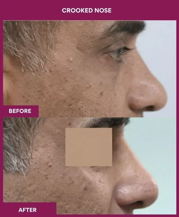 crooked-nose-rhinoplasty-before-after-results-mumbai-india-patient04-side-right