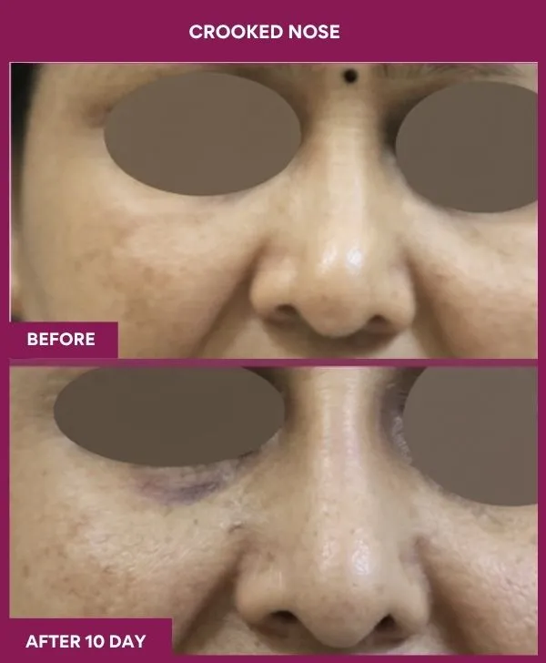 crooked-nose-rhinoplasty-before-after-results-mumbai-india-patient10-front