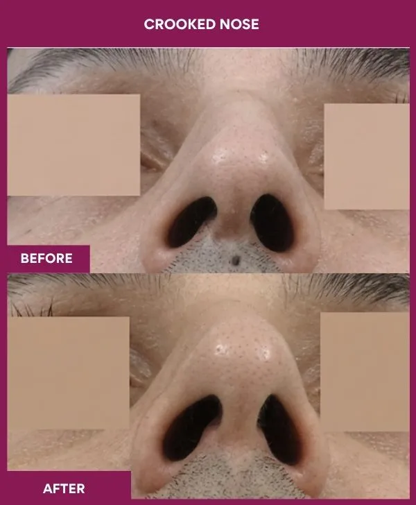 crooked-nose-rhinoplasty-before-after-results-mumbai-india-patient12-front-up