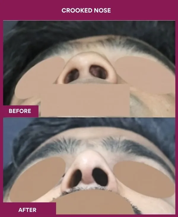 crooked-nose-rhinoplasty-before-after-results-mumbai-india-patient13-front