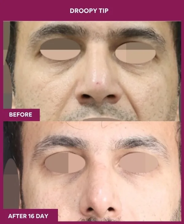 droopy-tip-rhinoplasty-before-after-results-mumbai-india-patient01-front