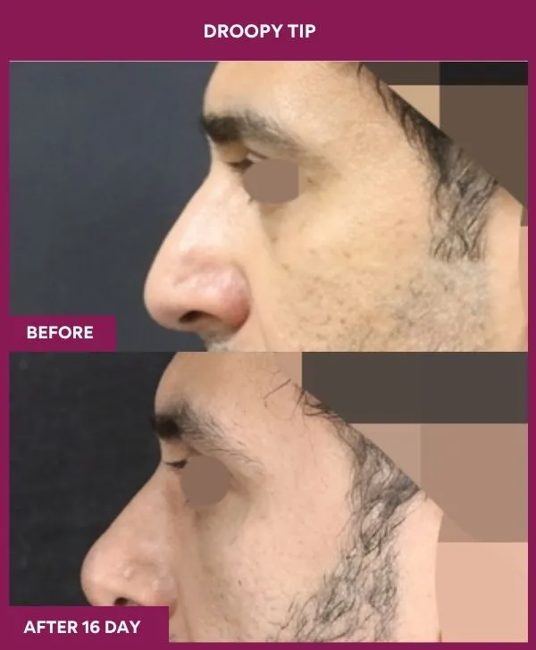 droopy-tip-rhinoplasty-before-after-results-mumbai-india-patient01-side-left