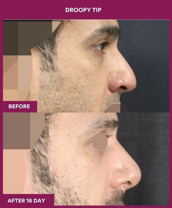 droopy-tip-rhinoplasty-before-after-results-mumbai-india-patient01-side-right