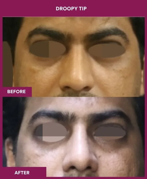 droopy-tip-rhinoplasty-before-after-results-mumbai-india-patient02-front
