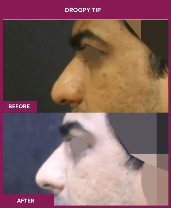 droopy-tip-rhinoplasty-before-after-results-mumbai-india-patient02-side-left