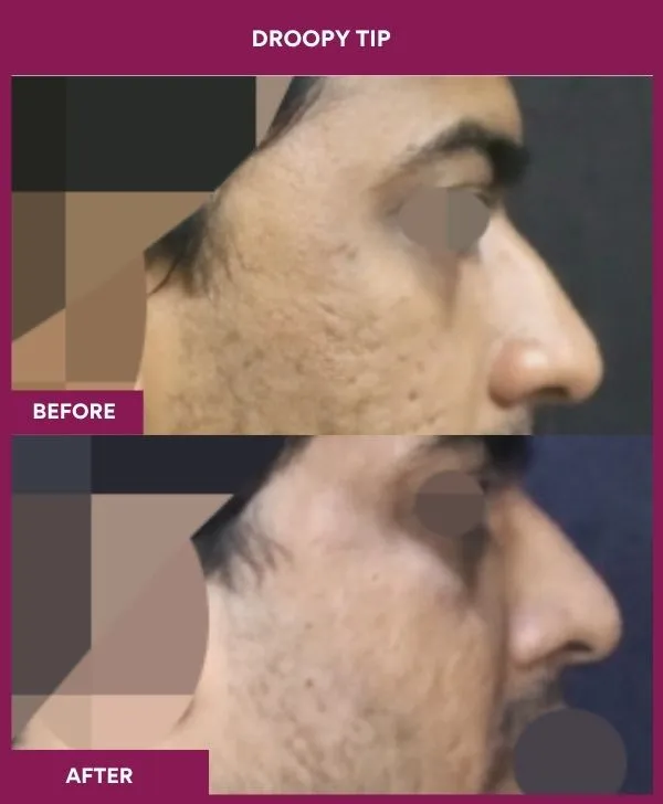 droopy-tip-rhinoplasty-before-after-results-mumbai-india-patient02-side-right
