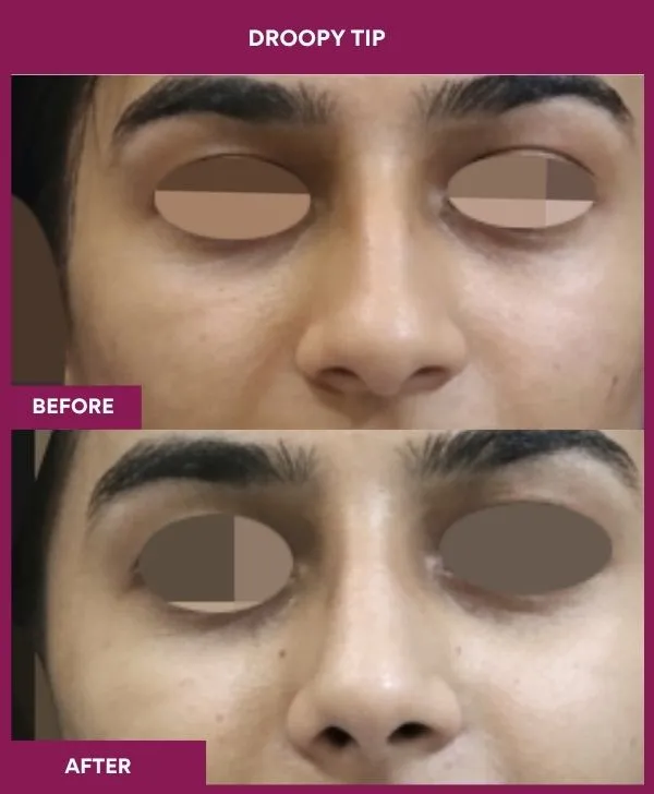 droopy-tip-rhinoplasty-before-after-results-mumbai-india-patient03-front