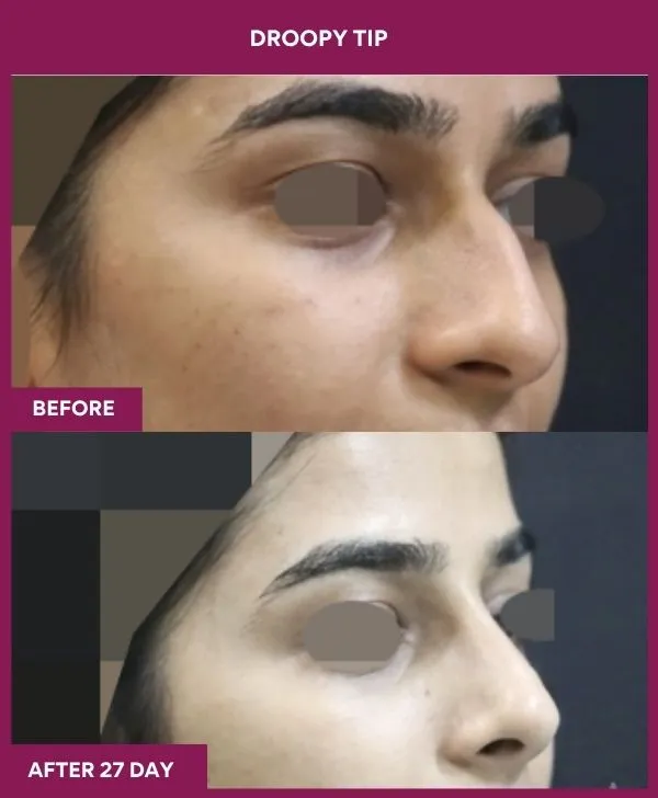 droopy-tip-rhinoplasty-before-after-results-mumbai-india-patient03-side-right-tilt