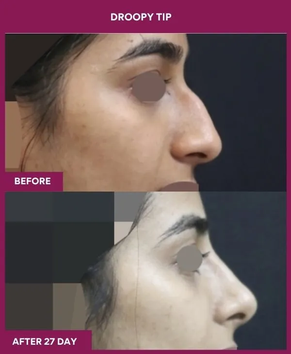 droopy-tip-rhinoplasty-before-after-results-mumbai-india-patient03-side-right