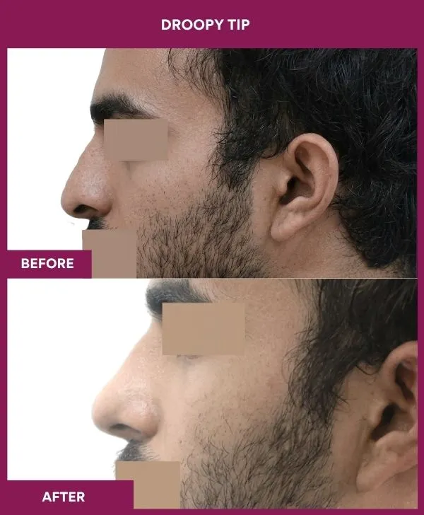droopy-tip-rhinoplasty-before-after-results-mumbai-india-patient04-side-left