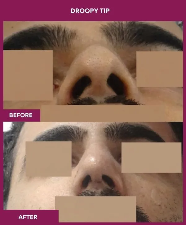 droopy-tip-rhinoplasty-before-after-results-mumbai-india-patient04-upward-front