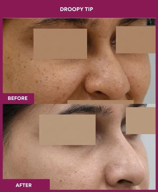 droopy-tip-rhinoplasty-before-after-results-mumbai-india-patient05-side-right