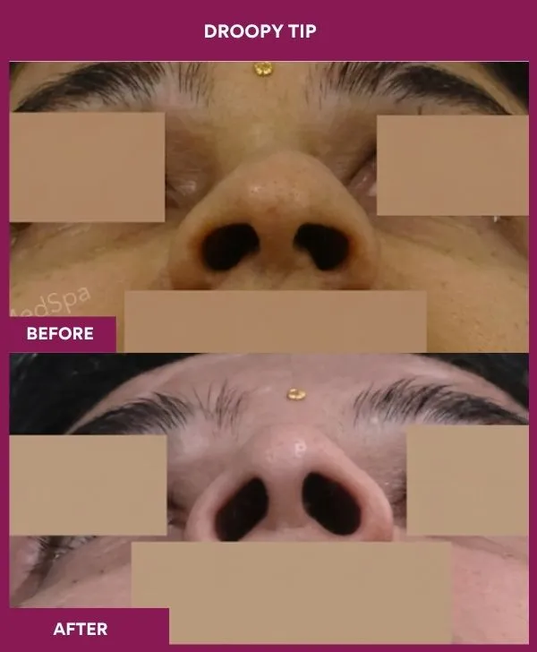 droopy-tip-rhinoplasty-before-after-results-mumbai-india-patient05-upward-front