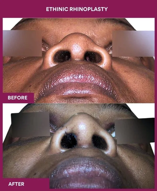 ethinic-rhinoplasty-before-after-results-mumbai-india-patient01-front