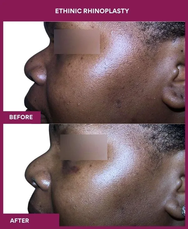 ethinic-rhinoplasty-before-after-results-mumbai-india-patient01-side-left