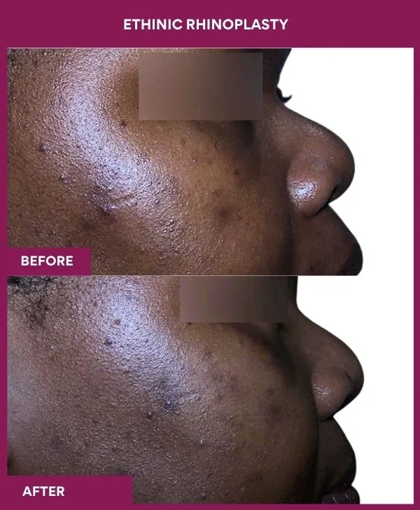 ethinic-rhinoplasty-before-after-results-mumbai-india-patient01-side-right