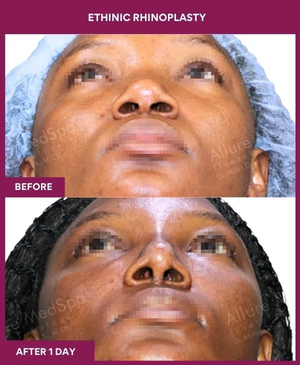 ethinic-rhinoplasty-before-after-results-mumbai-india-patient02-front