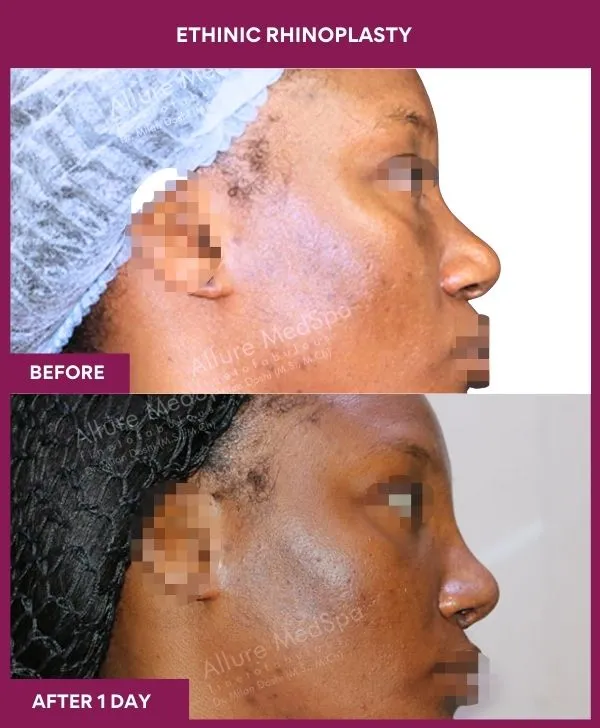 ethinic-rhinoplasty-before-after-results-mumbai-india-patient02-side-right