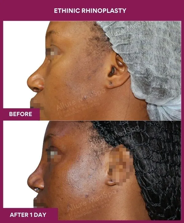 ethinic-rhinoplasty-before-after-results-mumbai-india-patient03-side-left