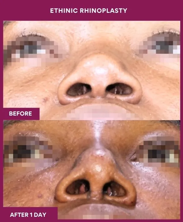 ethinic-rhinoplasty-surgery-before-after-results-mumbai-india-patient01-front