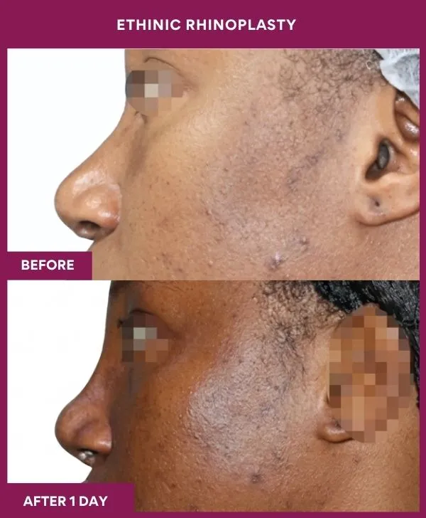 ethinic-rhinoplasty-surgery-before-after-results-mumbai-india-patient01-side-left