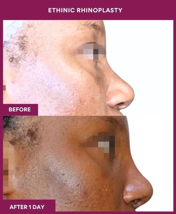 ethinic-rhinoplasty-surgery-before-after-results-mumbai-india-patient01-side-right