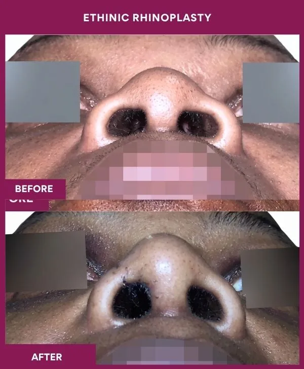 ethinic-rhinoplasty-surgery-before-after-results-mumbai-india-patient02-front