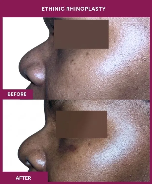 ethinic-rhinoplasty-surgery-before-after-results-mumbai-india-patient02-side-left