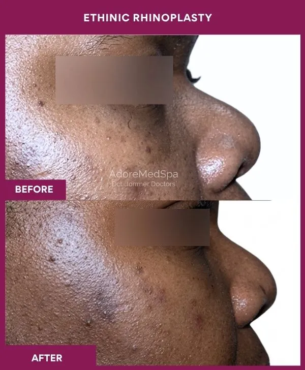 ethinic-rhinoplasty-surgery-before-after-results-mumbai-india-patient02-side-right