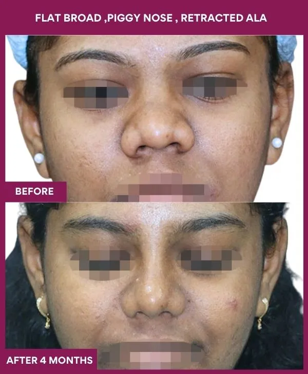 flat-broad-piggy-nose-before-after-results-mumbai-india-patient01-front