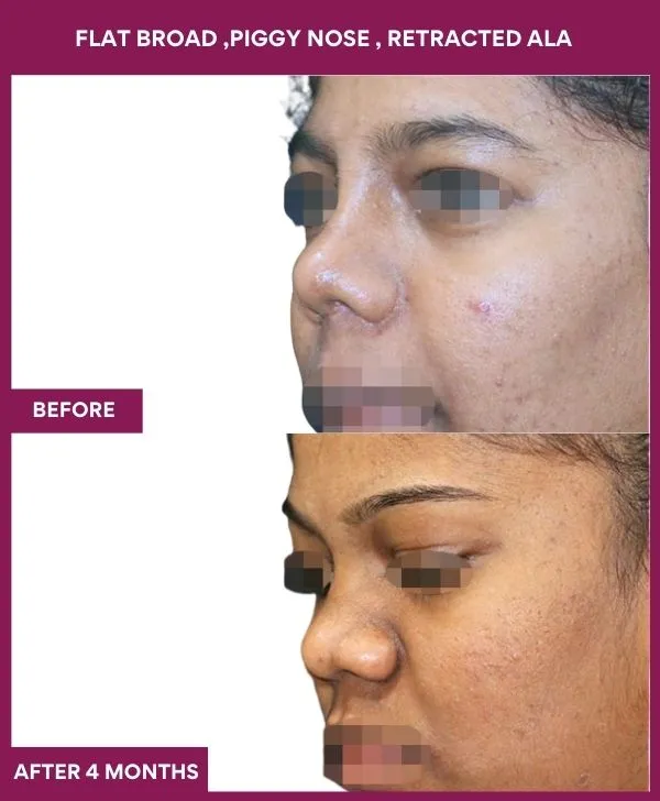 flat-broad-piggy-nose-before-after-results-mumbai-india-patient01-side-left