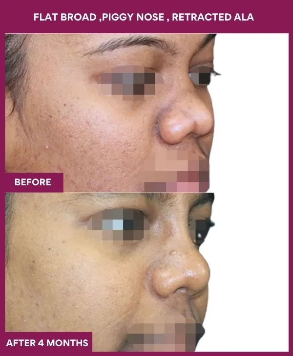 flat-broad-piggy-nose-before-after-results-mumbai-india-patient01-side-right