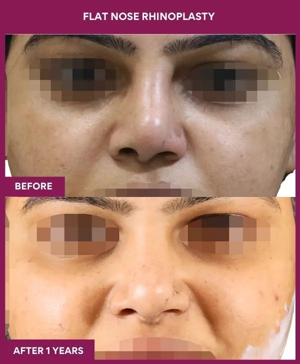 flat-nose-rhinoplasty-before-after-results-mumbai-india-patient02-front