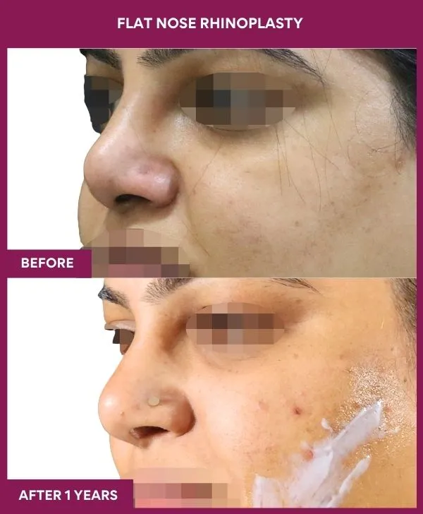 flat-nose-rhinoplasty-before-after-results-mumbai-india-patient02-side-left
