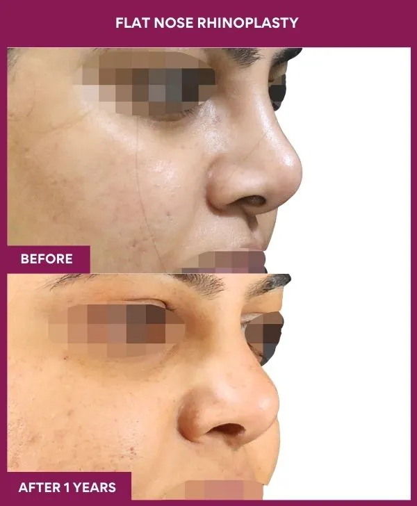 flat-nose-rhinoplasty-before-after-results-mumbai-india-patient02-side-right